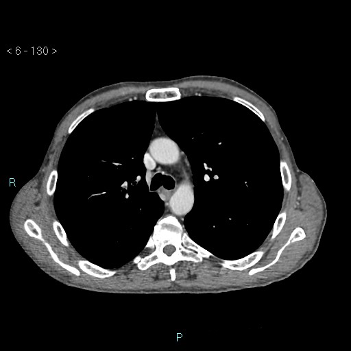 Colonic cancer (ultrasound and TC imaging) (Radiopaedia 50346-55713 B 130).jpg