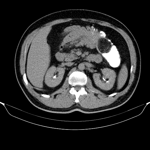 Colonic lipoma with colo-colic intussusception (Radiopaedia 58944-66200 Axial C+ rectal 20).jpg