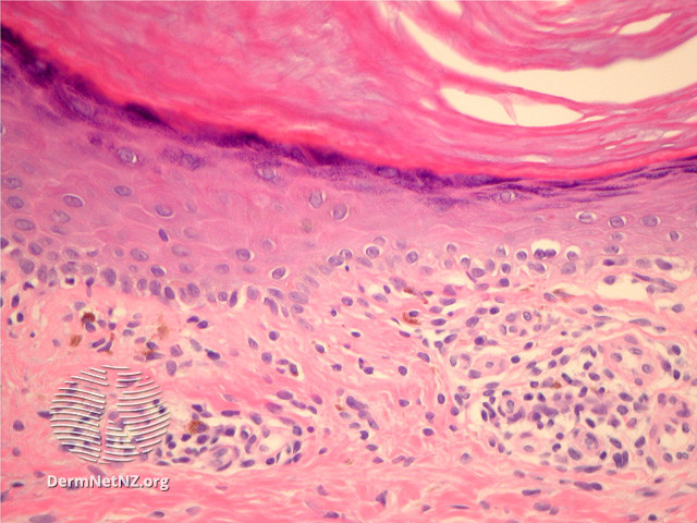 File:Figure 2 (DermNet NZ pathology-e-lichen-striatus-figure-2).jpg