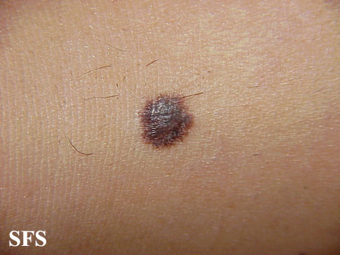 File:Melanoma (Dermatology Atlas 14).jpg