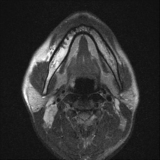 File:Nasopharyngeal carcinoma with pterygopalatine fossa involvement (Radiopaedia 33102-34134 Axial T2 5).png