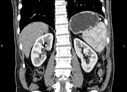 Necrotizing pancreatitis (Radiopaedia 87796-104248 F 49).jpg