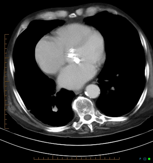 Necrotzing fasciitis due to a perforated adenocarcinoma of the splenic flexure (Radiopaedia 46930-51455 A 9).jpg