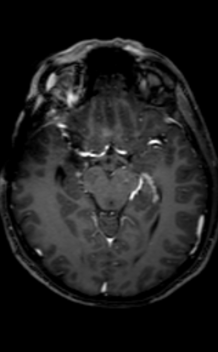 Neuro-Behçet disease (Radiopaedia 90112-107294 Axial T1 C+ 142).jpg