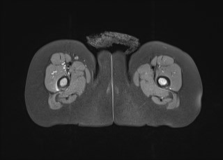 File:Neuroblastoma with bone metastases (Radiopaedia 67080-76414 Axial T1 C+ fat sat 37).jpg