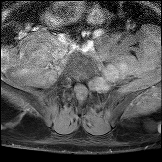 File:Neurofibromatosis type 1- extensive spinal involvement and Christmas tree sign (Radiopaedia 60610-68332 Axial T1 C+ fat sat 42).jpg