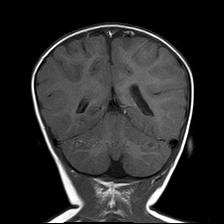 File:Neurofibromatosis type 1 (Radiopaedia 30089-30671 Coronal T1 21).jpg