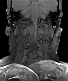 File:Neurofibromatosis type 1 (Radiopaedia 80355-93740 Coronal T1 6).jpg