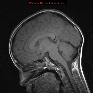 File:Neurofibromatosis type 1 with optic nerve glioma (Radiopaedia 16288-15965 Sagittal T1 12).jpg