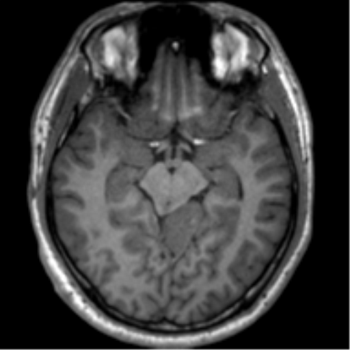 File:Neurofibromatosis type 2 (Radiopaedia 44936-48838 Axial T1 56).png