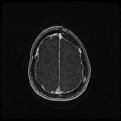 Neurofibromatosis type 2 (Radiopaedia 45229-49244 Axial T1 C+ 95).png