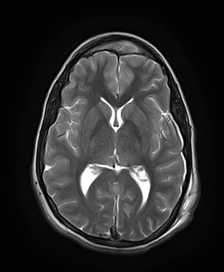 File:Neurofibromatosis type 2 (Radiopaedia 66211-75401 Axial T2 17).jpg