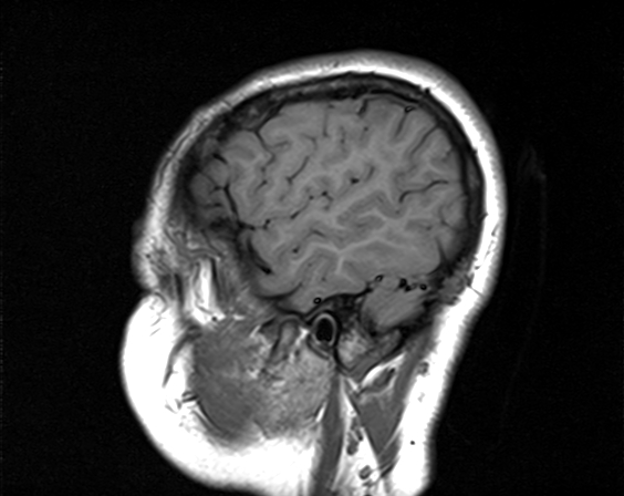 File:Neurofibromatosis type 2 (Radiopaedia 66211-75401 Sagittal T1 4).jpg