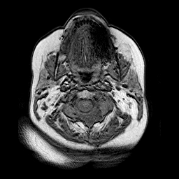File:Neurofibromatosis type 2 (Radiopaedia 8713-9518 Axial T1 27).jpg