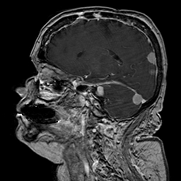 File:Neurofibromatosis type 2 (Radiopaedia 8713-9518 Sagittal T1 C+ 20).jpg