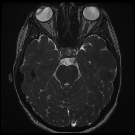 Neurofibromatosis type 2 - bilateral acoustic neuromata (Radiopaedia 40060-42566 Axial FIESTA 69).png