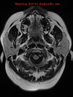 File:Neuroglial cyst (Radiopaedia 10713-11184 Axial FLAIR 22).jpg