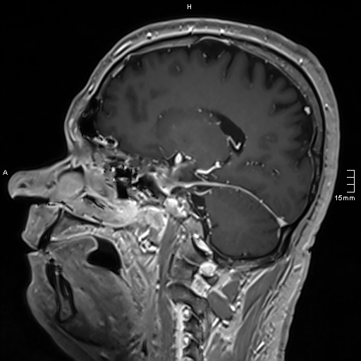 Neurosarcoidosis - involvement of the mesial temporal lobes (Radiopaedia 67429-76820 Sagittal T1 C+ 69).jpg