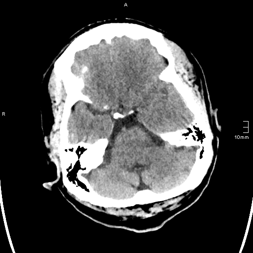 File:Neurotoxoplasmosis - concentric target sign (Radiopaedia 70644-80783 Axial non-contrast 8).jpg