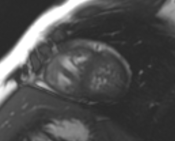 File:Non-compaction of the left ventricle (Radiopaedia 69436-79314 Short axis cine 67).jpg