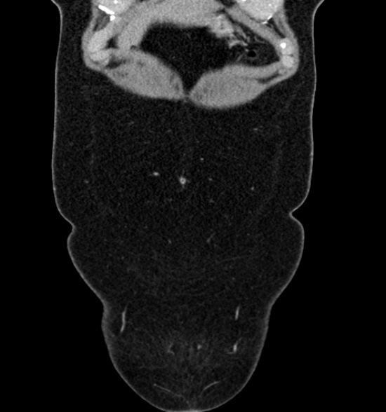 File:Normal CT intravenous urogram (Radiopaedia 39444-41759 A 163).jpg