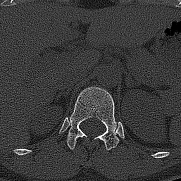 File:Normal CT lumbar spine (Radiopaedia 53981-60118 Axial bone window 1).jpg