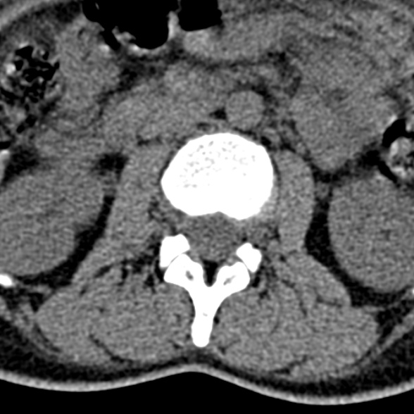 Normal CT lumbar spine (Radiopaedia 53981-60118 Axial non-contrast 41).jpg