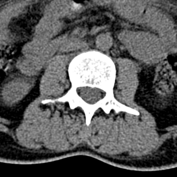 Normal CT lumbar spine (Radiopaedia 53981-60118 Axial non-contrast 49).jpg