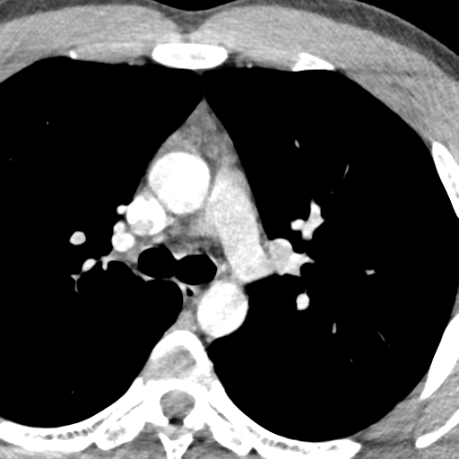 File:Normal CT pulmonary veins (pre RF ablation) (Radiopaedia 41748-44702 A 45).png