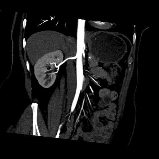 File:Normal CT renal artery angiogram (Radiopaedia 38727-40889 D 10).png