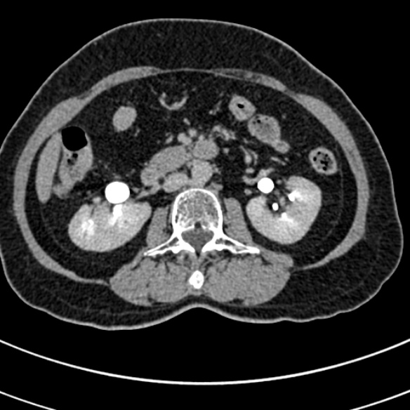 File:Normal CT split bolus study of the renal tract (Radiopaedia 48631-53634 Axial split bolus 94).jpg
