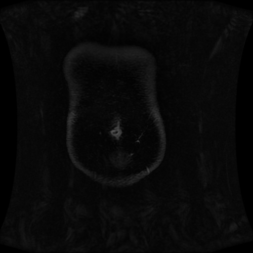 Normal MRI abdomen in pregnancy (Radiopaedia 88001-104541 M 18).jpg