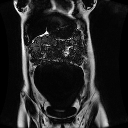 Normal MRI abdomen in pregnancy (Radiopaedia 88001-104541 N 43).jpg