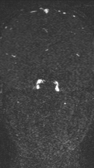 Normal MRI brain with MRV- teenager (Radiopaedia 49425-54553 Coronal MRV 124).jpg
