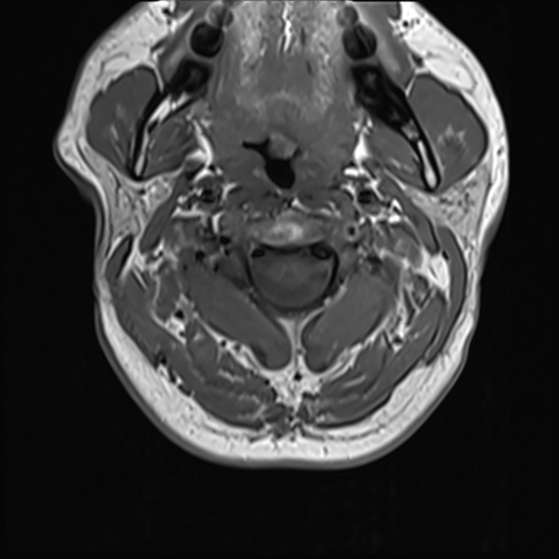 File:Normal MRI cervical spine (infection protocol) (Radiopaedia 53916-60039 Axial 14).png