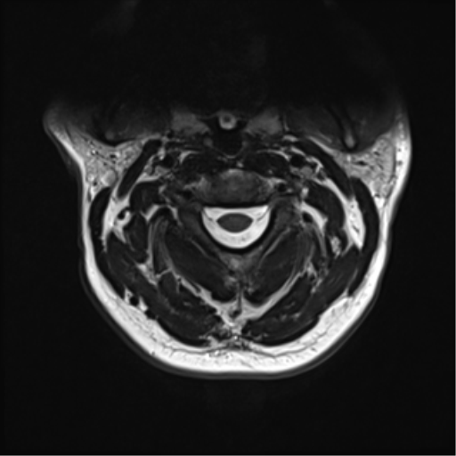 File:Normal MRI cervical spine (infection protocol) (Radiopaedia 53916-60039 Axial T2 15).png