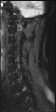File:Normal MRI cervical spine (infection protocol) (Radiopaedia 53916-60039 Sagittal DWI 3).png