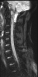 File:Normal MRI cervical spine (infection protocol) (Radiopaedia 53916-60039 Sagittal DWI 5).png