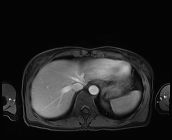 Normal adrenal glands MRI (Radiopaedia 82017-96004 K 13).jpg