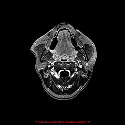 Normal adult brain MRI (non-enhanced and contrast-enhanced) (Radiopaedia 75262-86379 Axial T1 C+ 17).jpg