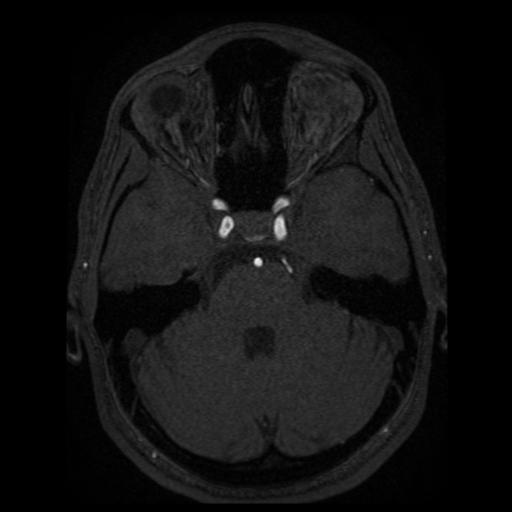 Normal brain MRA (Radiopaedia 41046-43793 Axial MRA 73).png