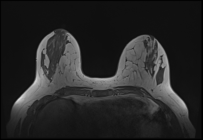 File:Normal breast MRI - dense breasts (Radiopaedia 80454-93850 Axial T1 79).jpg