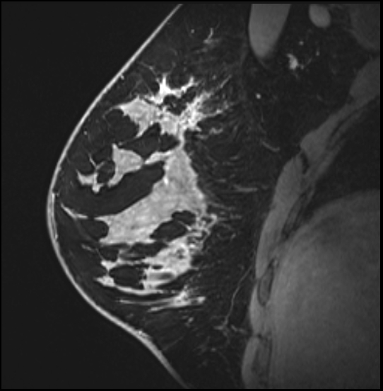 Normal breast MRI - dense breasts (Radiopaedia 80454-93850 I 68).jpg