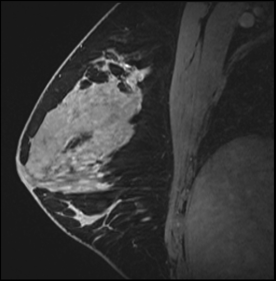 Normal breast MRI - dense breasts (Radiopaedia 80454-93850 I 95).jpg