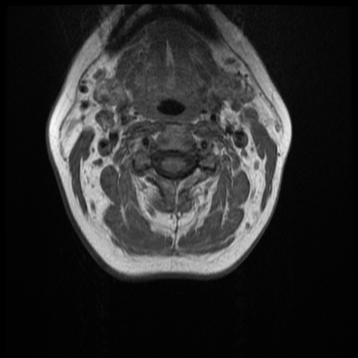 File:Normal cervical and thoracic spine MRI (Radiopaedia 35630-37156 Axial T1 24).png