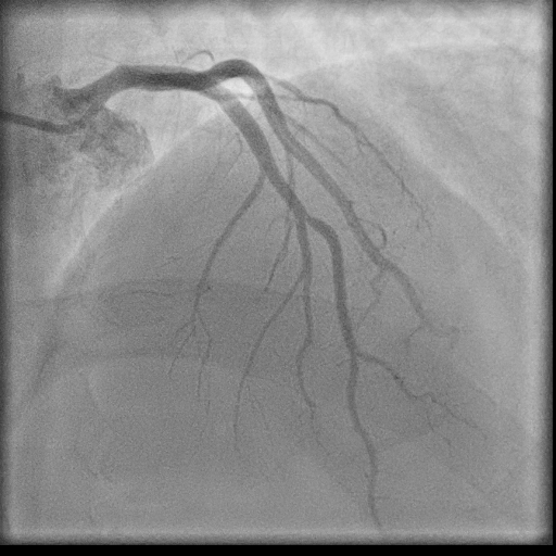 Normal coronary angiogram (DSA) (Radiopaedia 63081-71571 E 29).jpg