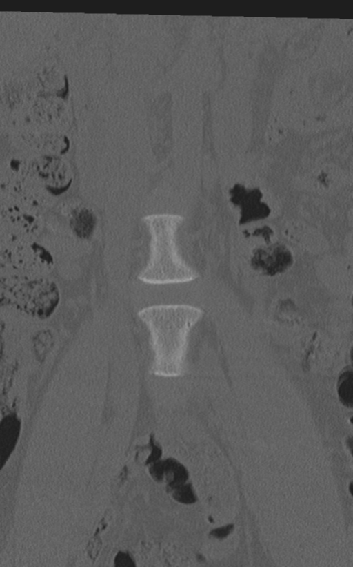 Normal lumbar spine CT (Radiopaedia 46533-50986 Coronal bone window 13).png