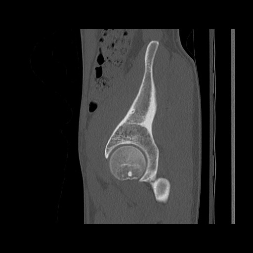 Normal pelvis (Radiopaedia 51473-57238 Sagittal bone window 38).jpg