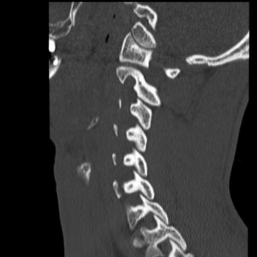 File:Normal trauma cervical spine (Radiopaedia 41017-43760 Sagittal bone window 33).png