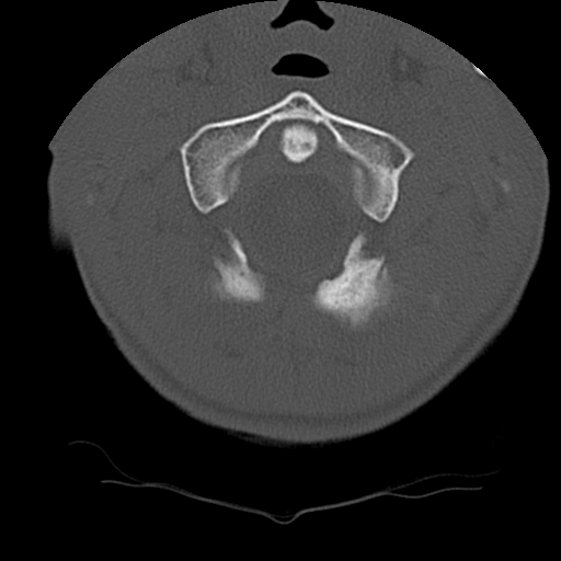 File:Normal trauma spine imaging (age 16) (Radiopaedia 45335-49358 Axial bone window 8).jpg